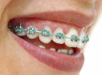 L'orthodontie:le b.a-ba